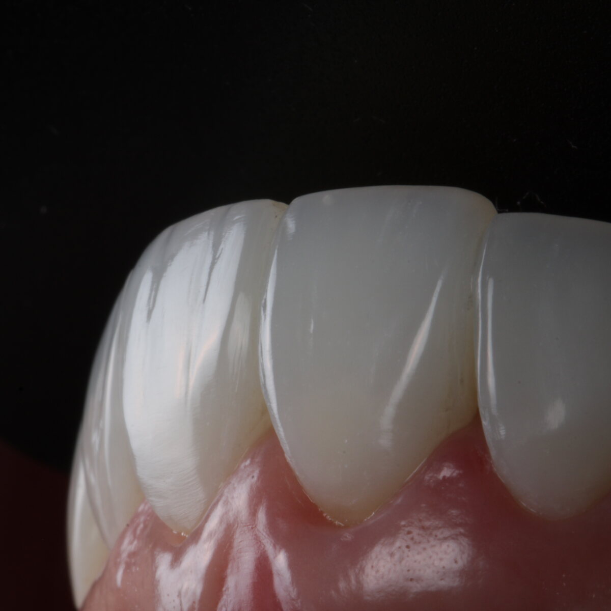 Polimento de restauração em dentes anteriores