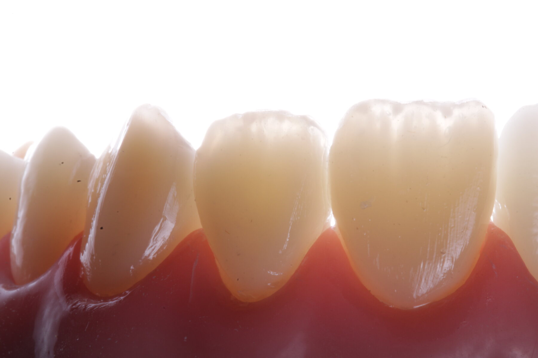 Resultado estético em dentes anteriores
