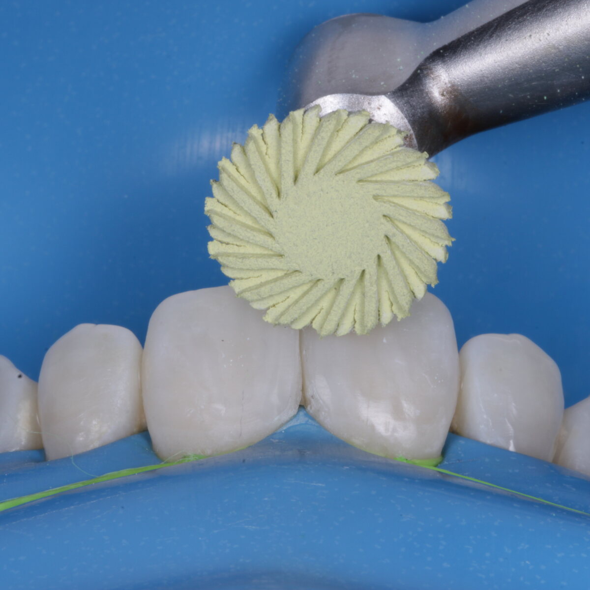 Detalhe clínico de restauração em dente anterior